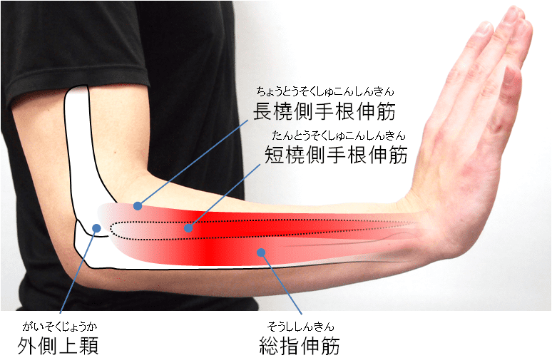 上腕骨外側上顆炎（テニス肘）の病態・原因